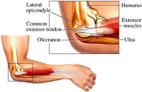 Tennis Elbow Australia South Coast