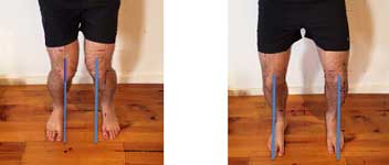 Knee dropping inside the big toe: incorrect  Knee in line with the 2nd to 3rd toes: correct