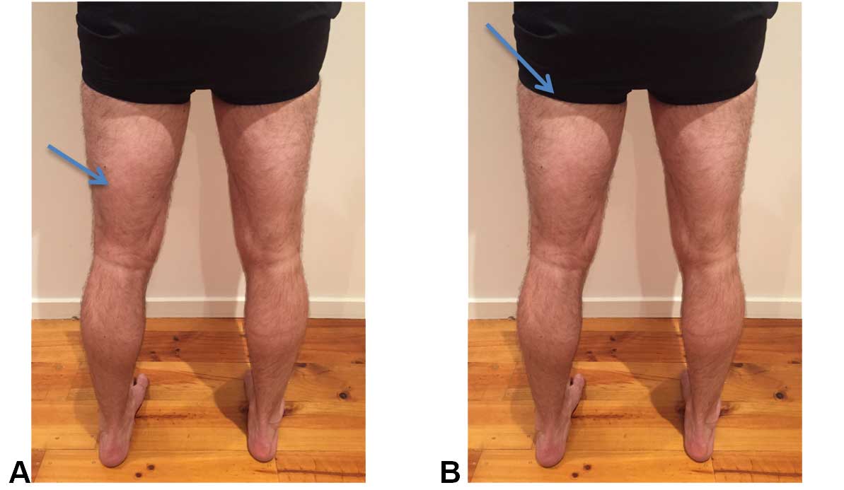 Hamstring Injury Prevention Hamstring Injury Management