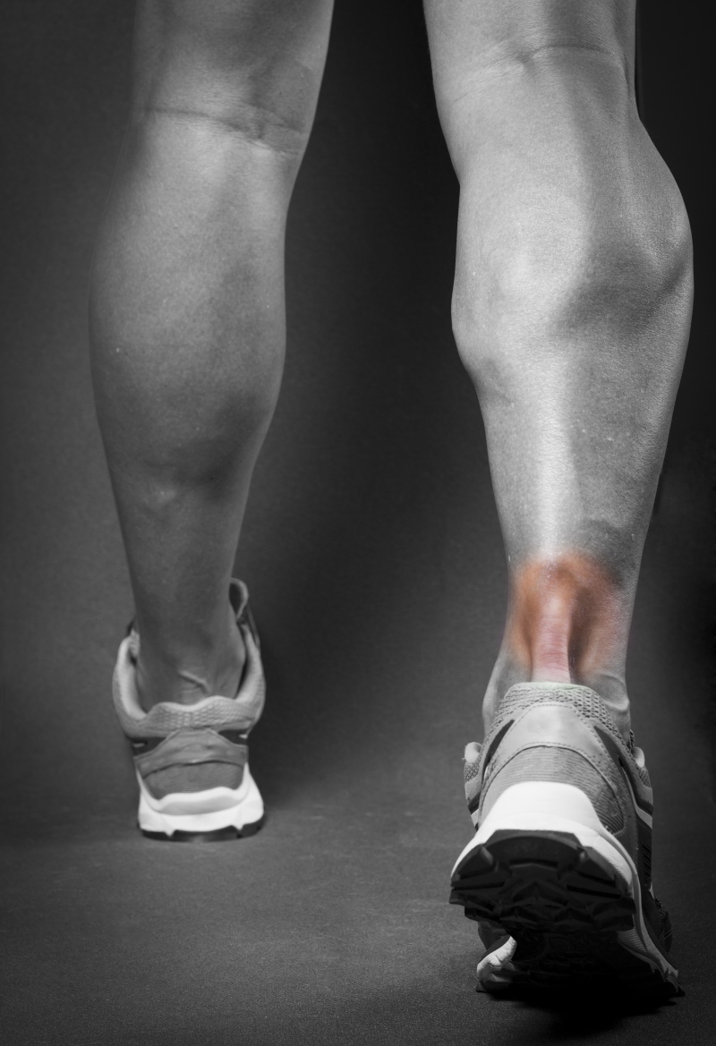 Achilles Tendon Rupture - The importance of rehabilitation